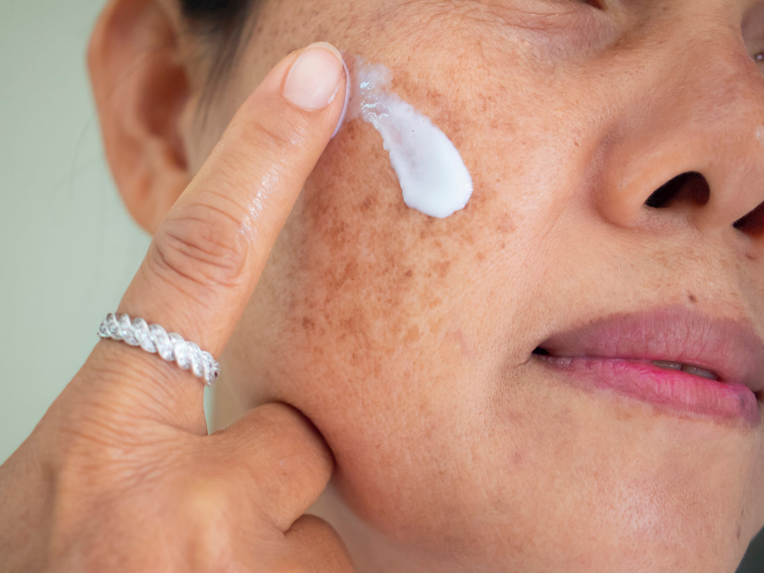 Pigmentation and Melasma: What You Need to Know